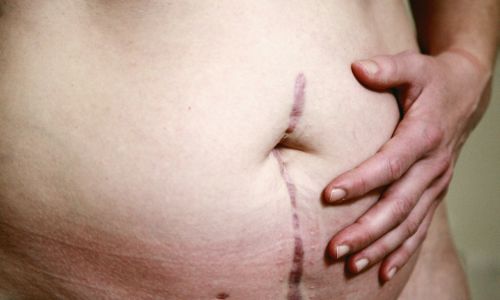 woman cradling her scarred stomach